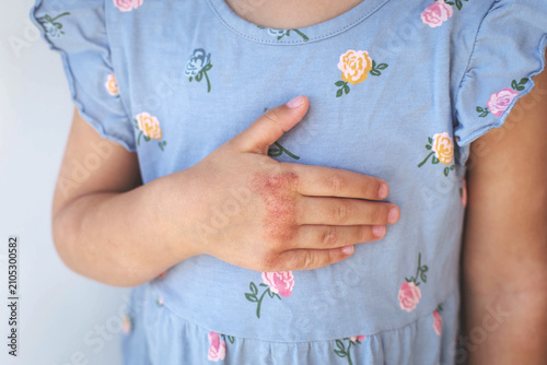 Quadro su tela Dry eczema rash on child hand with inflamed irritated skin, closeup showing atop