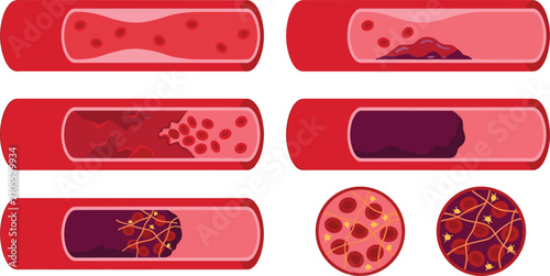 Foto Blood Clot Thrombosis and Artery Blockage Cross Section Vector Diagram Set Showi