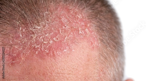 Close-up of human scalp with dry flaky dandruff, seborrheic dermatitis, and irritated red skin showing signs of psoriasis or eczema. AI generated.
