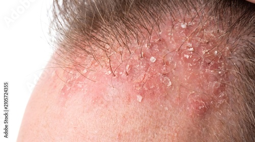 Close-up of human scalp with dry flaky dandruff, seborrheic dermatitis, and irritated red skin showing signs of psoriasis or eczema. AI generated.
