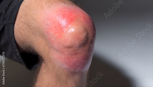 Severe prepatellar bursitis on swollen knee joint, leg pain and trauma concept, medical healthcare reference photography