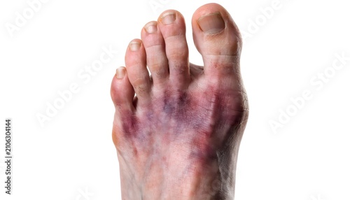 Foot drop trauma bruise on dorsal skin surface, top down view for physical therapy, rehab, and podiatry education
