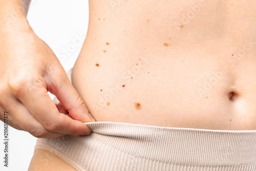 Konstfotografi Woman checking moles on her abdomen skin