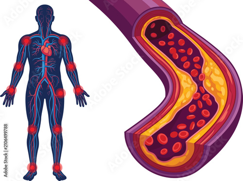 Tableau sur toile Atherosclerosis and human circulatory system vector illustration showing cholest