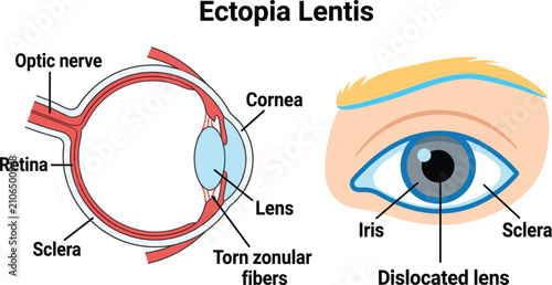 Fotografía Ectopia Lentis showing eye anatomy, torn zonular fibers, and dislocated lens
