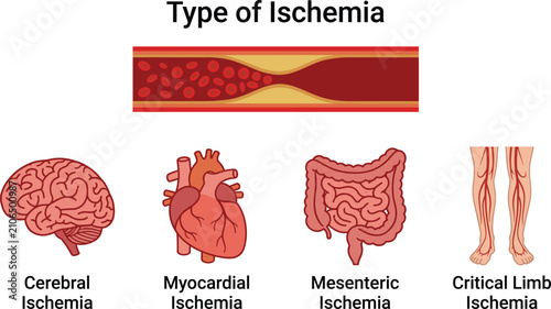 Принти на полотні Types of ischemia vector illustration, cerebral, myocardial, mesenteric, and cri