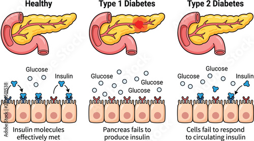 Bild auf Leinwand Vector illustration comparing healthy pancreas function to type one and type two