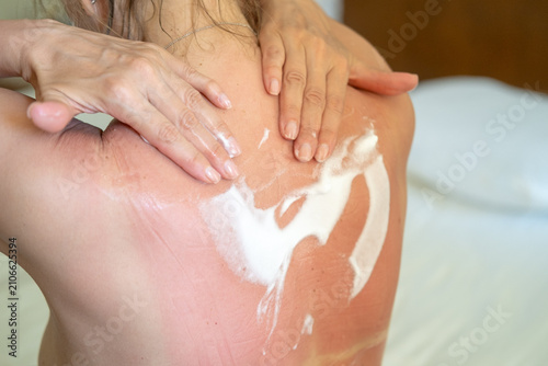 Schilderij op canvas Woman applying panthenol spray to her sunburned back, shoulders after prolonged sun exposure