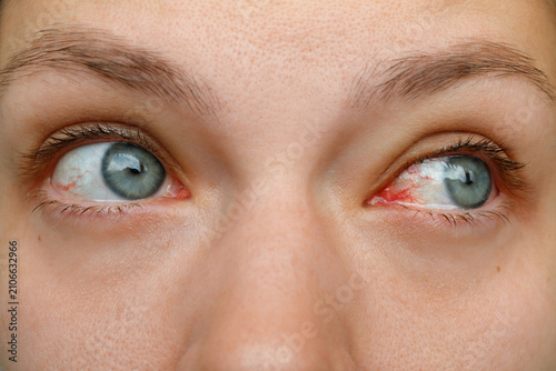 Tableau sur toile Close up of young woman look sideways showing red bloodshot eyes with burst bloo