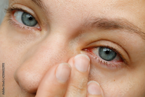 Cuadro en lienzo Close up of woman touching corner of red bloodshot eye with allergy conjunctivit
