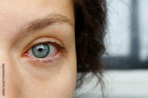 Cuadro en lienzo Close up of woman looking at camera showing one red bloodshot eye with allergy c