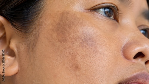 Close-up of woman’s face showing natural skin pigmentation and texture unevenness on cheek area