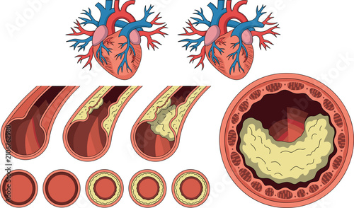 Fotografía Human Heart Anatomy and Atherosclerosis Progression Vector Infographic Set Showi