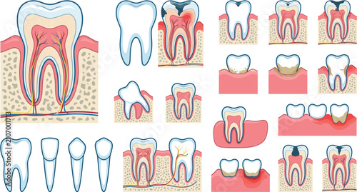 Bild auf Leinwand Dental anatomy and tooth decay vector diagram set featuring tooth structure cros