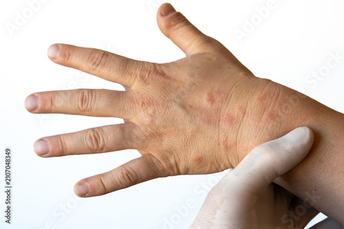 Принти на полотні Eczema on human hand close-up showing dry, red, inflamed skin