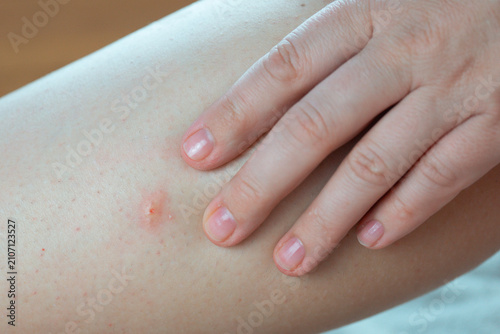 Foto hand with clean fingernails gently touches an inflamed insect bite on the skin o