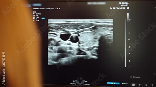 Medical ultrasound exam of the thyroid area shows details of the gland and surrounding tissues