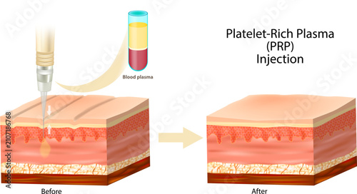 PRP Injection Therapy Skin Anatomy Cross Section Showing Platelet-Rich Plasma Treatment and Tissue Regeneration. Skin Regeneration Medical Illustration Before and After Skin 