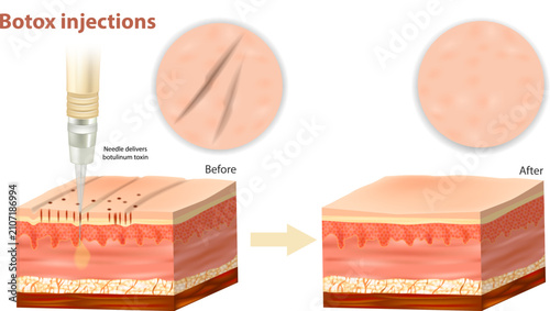 Botox Injections Before and After Skin Cross Section Showing Wrinkle Reduction and Botulinum Toxin Treatment. Botulinum Toxin Injection Mechanism Medical Illustration