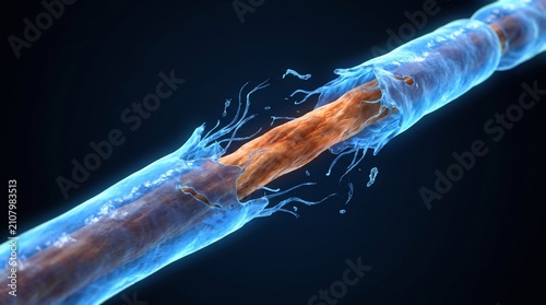 Close-up 3D medical render of a damaged nerve fiber with a peeling blue myelin sheath, highlighting the process of demyelination for clinical and educational use.