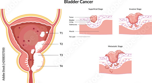 Bladder Cancer Medical Vector Illustration Showing Tumor Progression from Superficial to Invasive and Metastatic Stages with Urinary System Anatomy Diagram