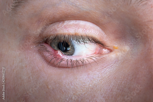 Фотография Hordeolum or stye close-up