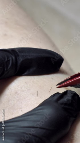 Permanent hair removal procedure by a specialist in a beauty clinic, using advanced medical equipment for precision. Extreme close-up shot.