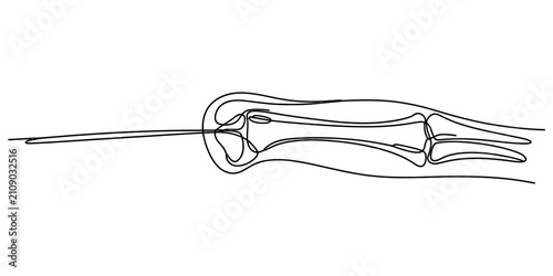Schilderij op canvas Medical illustration of a finger joint injection with a needle into the knuckle