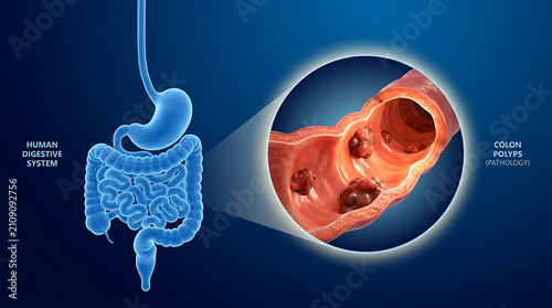 Human digestive system with colon polyps pathology
