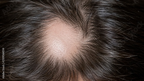 Close-up of scalp with bald spot surrounded by dark hair showing hair thinning condition