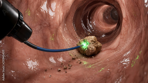 Endoscopic 3D view of laser lithotripsy crushing kidney stone inside ureter