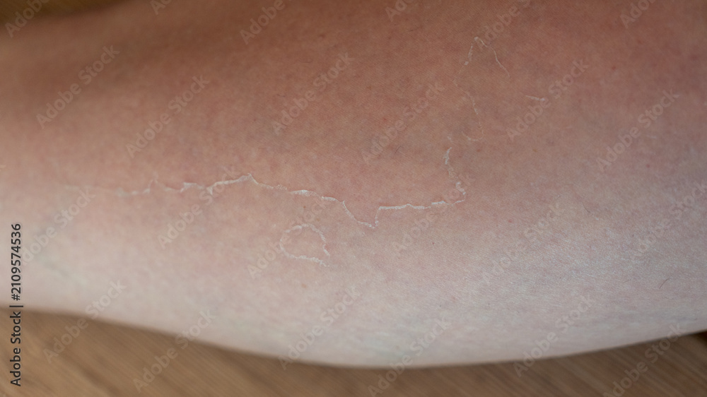 Fototapeta premium Skin peeling after sunburn. Skin problems, peeling, dead skin, epithelium. Leg