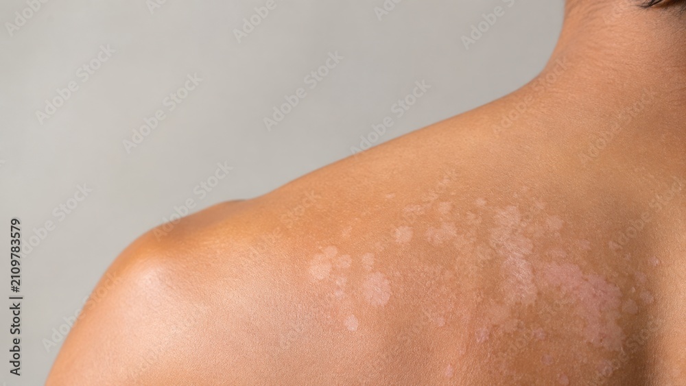 Fototapeta premium Close-up of human shoulder with skin discoloration and patchy areas on medium skin tone background