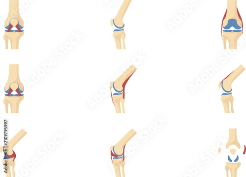Cuadro en lienzo Human Knee Joint Anatomy and Orthopedic Vector Illustration Set with Ligaments,