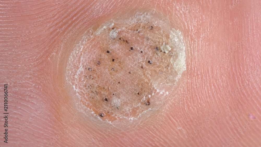 Fototapeta premium Macro of plantar wart verruca on sole of foot