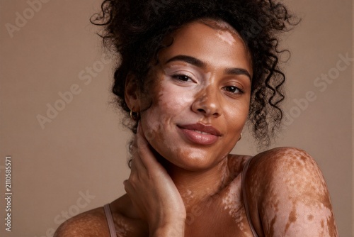Young woman with vitiligo smiling in studio portrait setting