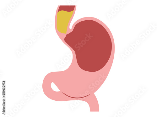 Bild auf Leinwand Achalasia Disease in Stomach Illustration