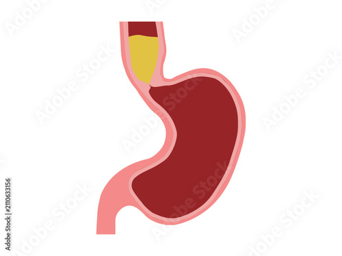 Achalasia Disease in Stomach Illustration