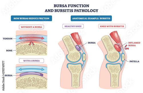 Canvas Print Bursa function and bursitis pathology illustrated with a knee cross-section, showing bursa, tendon, and inflamed sac that reduces friction then swells when irritated