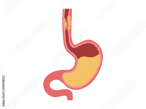 Esophageal Cancer Disease in Stomach
