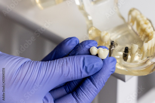 Double unit dental bridge with ceramic crowns on transparent typodont model