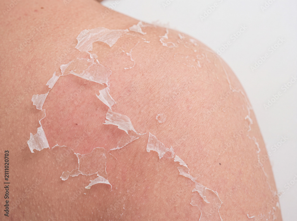 Fototapeta premium Macro Close-Up of Peeling Skin on Shoulder After Sunburn with Realistic Skin Texture