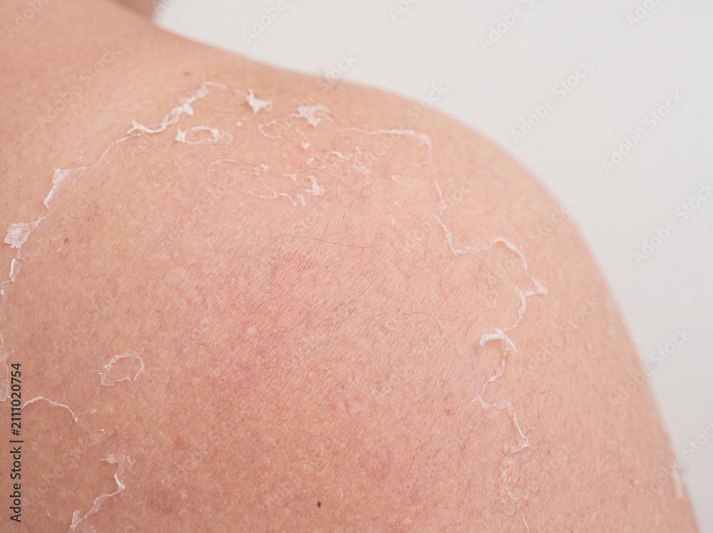 Fototapeta premium Macro Close-Up of Peeling Skin on Shoulder After Sunburn with Realistic Skin Texture