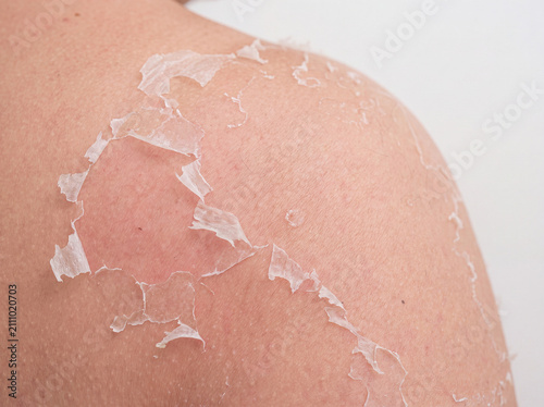 Macro Close-Up of Peeling Skin on Shoulder After Sunburn with Realistic Skin Texture