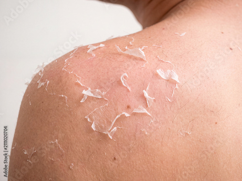 Macro Close-Up of Peeling Skin on Shoulder After Sunburn with Realistic Skin Texture