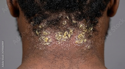 Rear view close-up of man neck and hairline with severe flaking, dandruff, seborrheic dermatitis, or psoriasis skin condition, scalp care concept