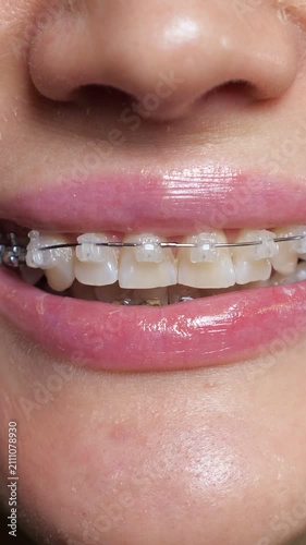 Macro view of a young woman's mouth with pink lipstick and braces smiling, illustrating orthodontic correction, cosmetic dentistry, and oral hygiene for a perfect smile
