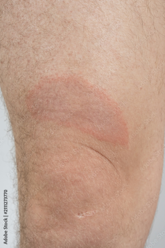 Fototapeta premium Close-up of circular red skin lesion characteristic of Borreliosis infection after a tick bite