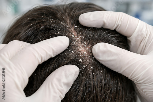Medical examination of scalp with dandruff flakes during dermatology consultation in clinical close up