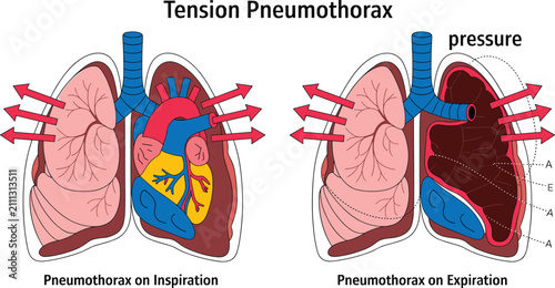 Tension Pneumothorax Medical Vector Illustration Comparing Inspiration and Expiration with Collapsed Lung Intrathoracic Pressure Respiratory Healthcare Educational Diagram